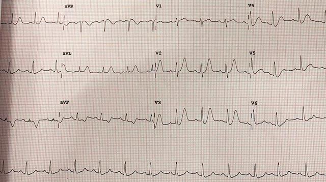 冠脉|罕见、危急、致命，这病的名字居然叫“寒冬来临”