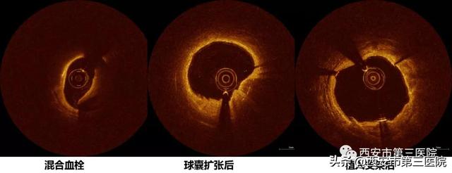 【精准治疗】西安市第三医院心内科首次使用OCT指导冠脉支架植入术