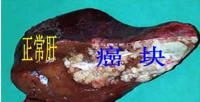 哪些人是肝癌高危人群？肝癌如何筛查？