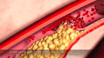 心肌梗死发作如何识别，如何自救？（附心梗地图）