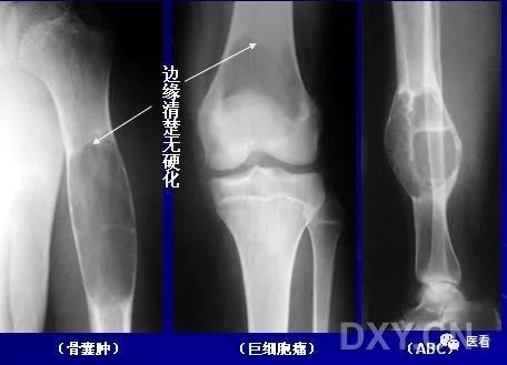 9个骨肿瘤医学影像诊断分析基本要点，如此精彩怎能错过