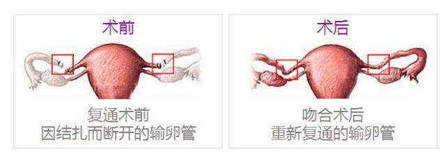 『你的育儿经』输卵管结扎好几年了，做复通手术怀孕几率高吗？