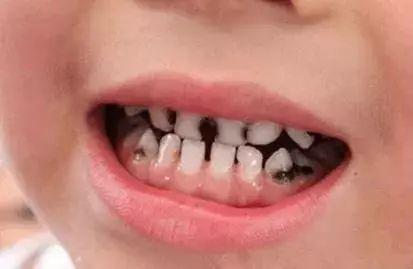 「你的育儿经」孩子不爱刷牙，是讲道理、吼一顿还是随他去？用游戏轻松化解