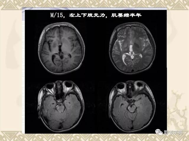 垂体病变的MRI诊断