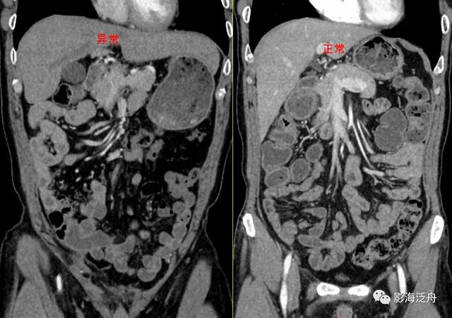 这个病，腹部CT经常会漏诊