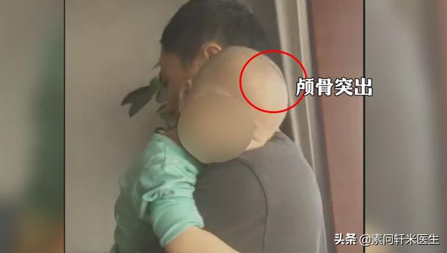『你的育儿经』过敏宝宝的家长请注意！又见“大头娃娃”，害人的假奶粉还在卖