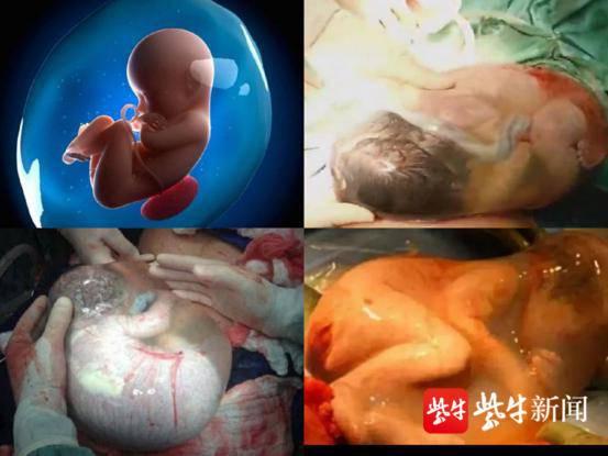 扬眼：很罕见：宝宝出生有完整羊膜囊“护体”，就像一个“巨型透明鸡蛋”