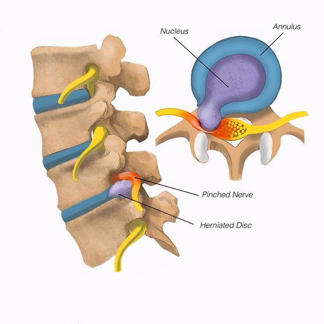 腰间盘突出症，除了药物治疗，康复锻炼是否可行，咋做？请看此文