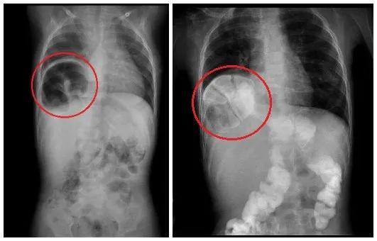 「广州日报」1岁幼儿频繁呕吐，医院一检查，胃不见了
