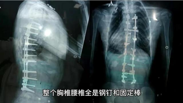 女士|孕妈胸腰椎布满钢钉 徐州瑞博产麻两科紧密配合2分钟挑战极限“秒生”