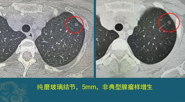 磨玻璃结节就是肺癌吗？