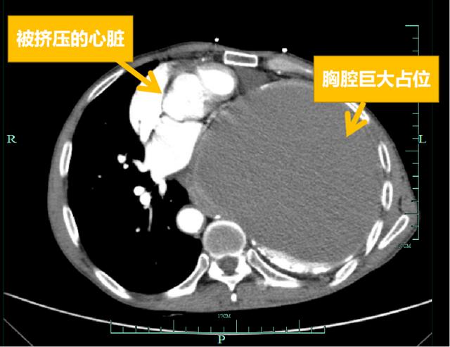 病人|仁爱医患故事?丨胸腔巨大占位，心脏被挤压！被判了“死刑”的他该何去何从？