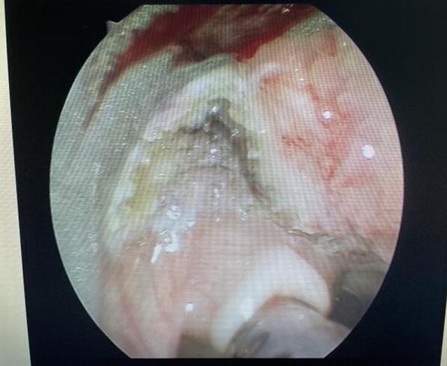 真·如鲠在喉！济一2个月小孩嗓子里长了巨大肿瘤