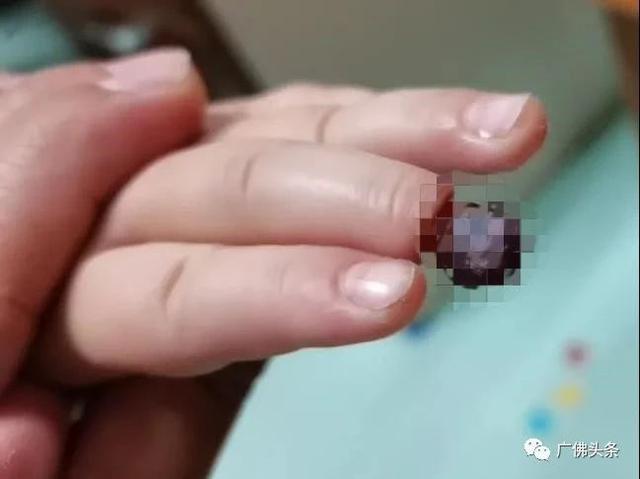 孩子|4岁女童玩着橡皮筋睡着了，险些面临截指……