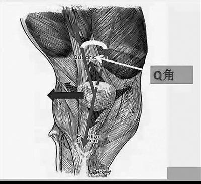 髌骨|走路膝关节总发软 当心髌骨脱位