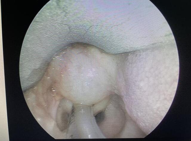 真·如鲠在喉！济一2个月小孩嗓子里长了巨大肿瘤