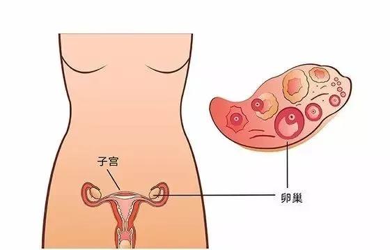 习惯性流产！“种子”不行还是“土地”的不挽留？