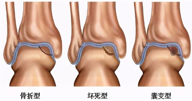 什么是距骨骨软骨损伤？