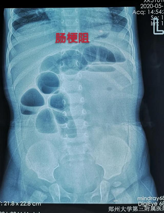 #大河微医#“海绵宝宝”成“杀手”, 一岁宝宝危在旦夕