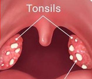 为什么孩子的扁桃体总发炎