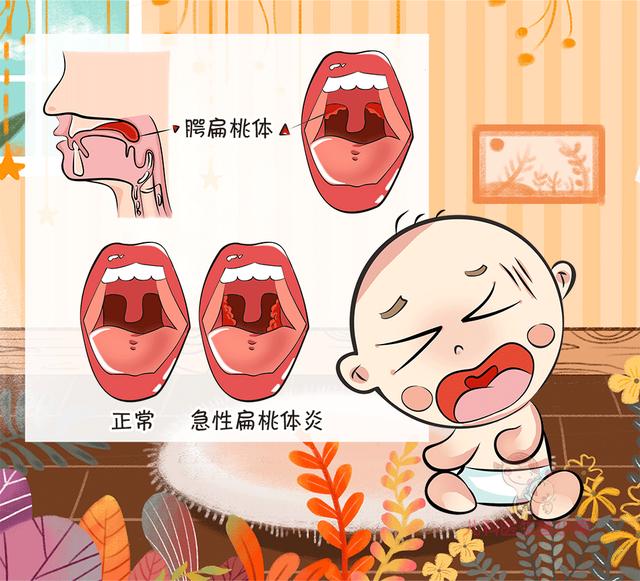「你的育儿经」反复发作的儿童扁桃体炎让你崩溃？这样就能标本兼治少发作