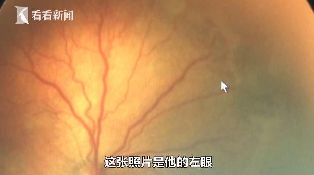 超级宝妈@8个月宝宝眼睛会“发光”医生一查发现情况不妙