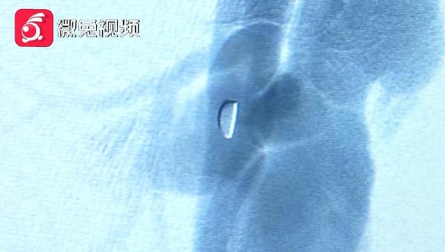 师傅|惊！贵阳一男子腿部剧痛、皮肤发黑！竟是铁片藏里面20多年