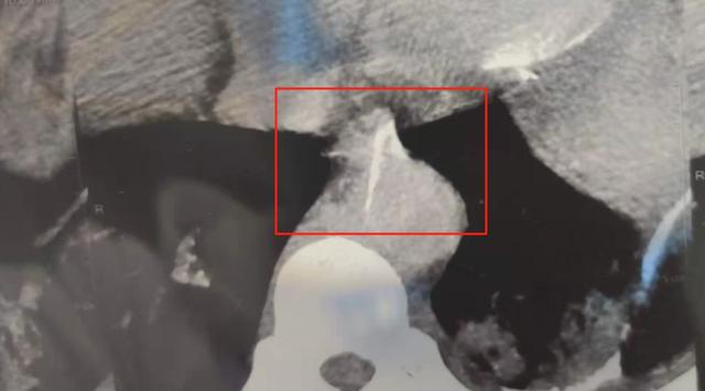 主动脉|10个科室30位专家参与大抢救，就因为一根鱼刺