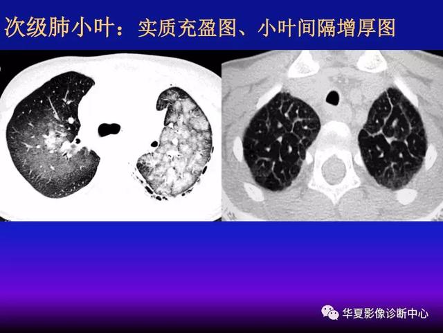 肺间质性疾病的解剖、病理、影像分析