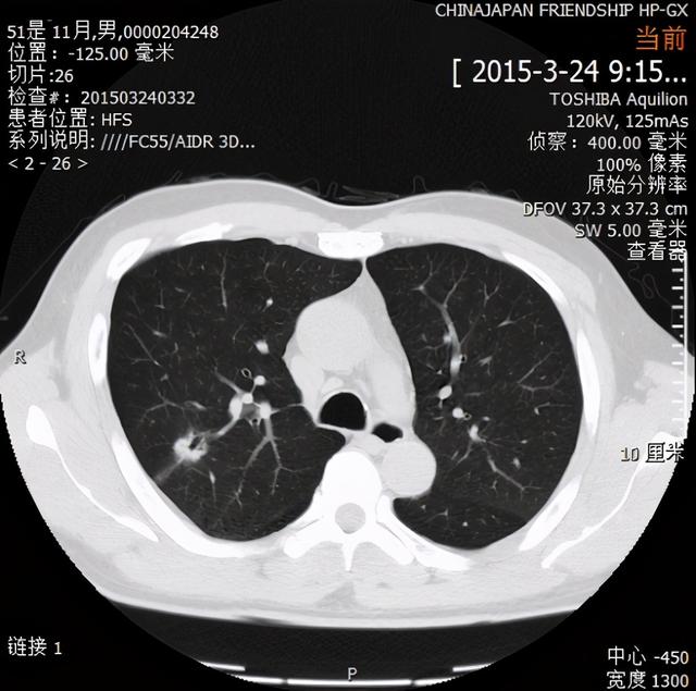 刘德若：对肺小结节和1a期肺癌应作何思考？（下）