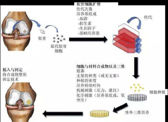 膝关节炎|膝关节炎的手术治疗（一）：软骨移植、膝关节镜。