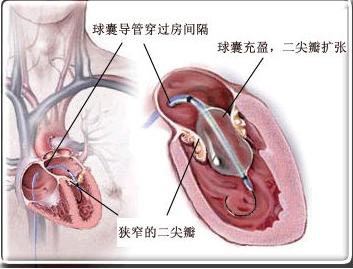你的育儿经|35岁女子怀孕仨月，突然胸闷气短无法躺卧！医生：这病起病隐匿，孕前检查很必要