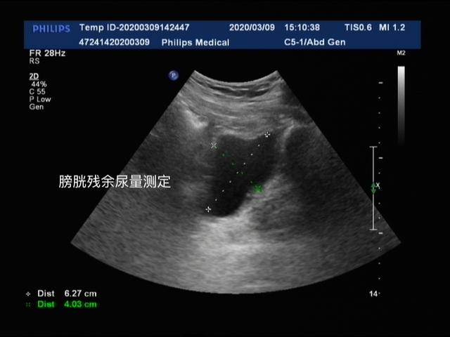 1分钟泌尿外科医生带你简单了解什么是泌尿系彩超