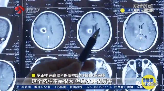 痘痘|警惕！挤了颗痘痘，瘫痪了