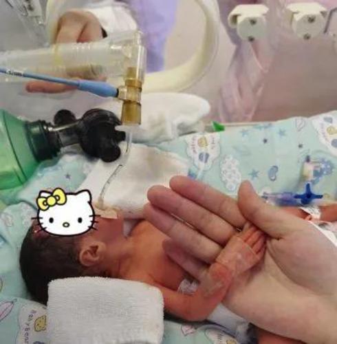 超级宝妈@胎龄6个多月的早产儿闯过几道生死关，平安回家了！