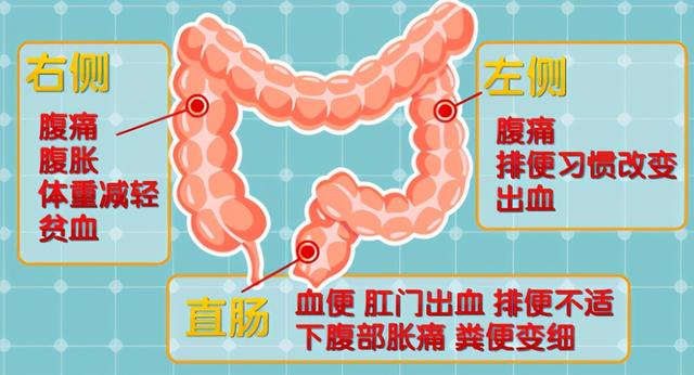 年年体检都“正常”，却还发现癌症晚期？医生：癌胚抗原不准确