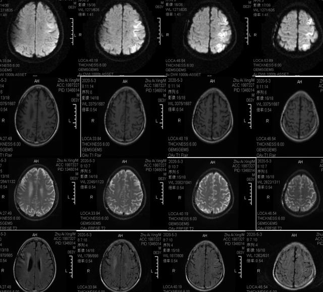 这例 DWI 高信号，不要误诊为脑梗死