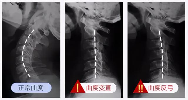 小米有品再出手，设计“耳机式”按摩仪，15档按摩力度随心调节