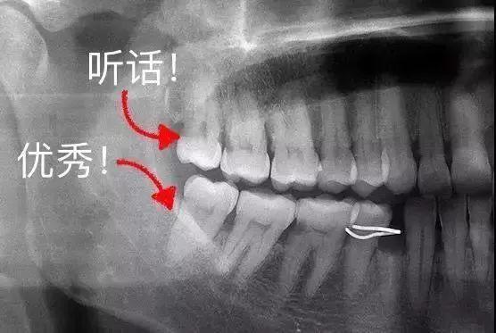 【科普】长了智齿该不该拔？这6类人别随意拔，严重时可危及生命.....