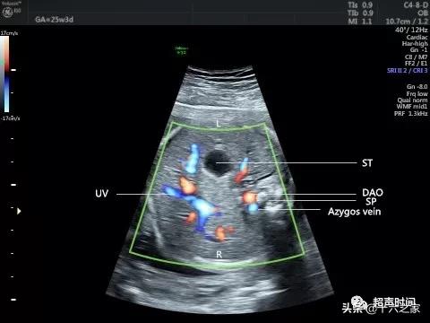 你的育儿经|胎儿下腔静脉缺如
