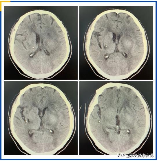 万一脑出血了，正规诊疗流程你知道吗？