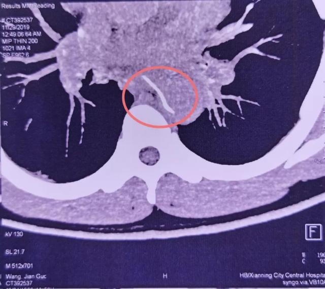 主动脉|10个科室30位专家参与大抢救，就因为一根鱼刺