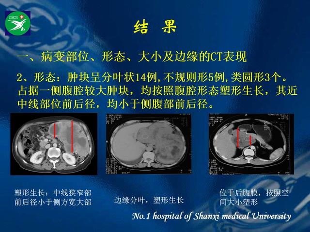 李健丁教授：胃肠道外间质瘤的CT表现和临床病理分析
