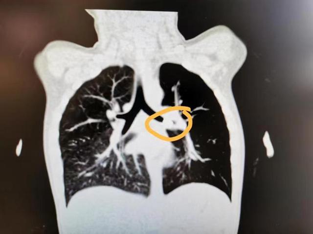 异物|4岁男孩肺炎反复三个月不见好，CT显示呼吸要道竟被“金属脚”封堵
