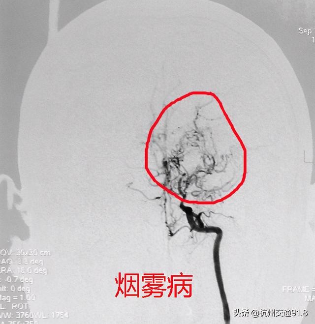 34岁杭州男子居然中风了，脑血管如同“烟雾”！妻子慌了神：平时他身体很好的