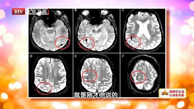 这类人群，吃阿司匹林可能很危险！做好一件事，脑出血早早早发现