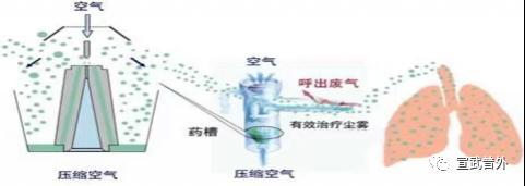 雾化|您真的了解雾化吸入吗？