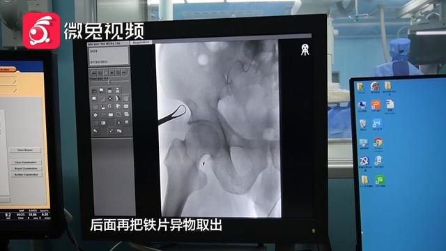 师傅|惊！贵阳一男子腿部剧痛、皮肤发黑！竟是铁片藏里面20多年