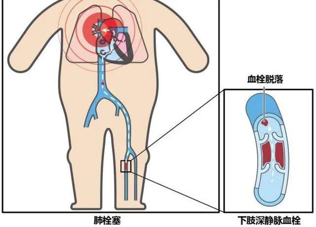 台州1频道丨「科普」24岁主播因为它差点猝死！肺栓塞有多可怕