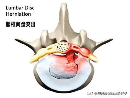 腰间盘|腰间盘突出症患者必须绝对卧床才能好吗？医生：适度活动会更好